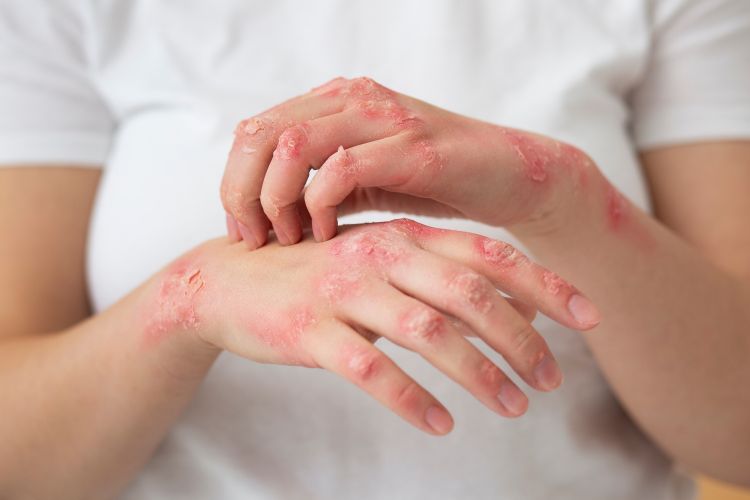 Dermatitis seborreica: qué es, por qué aparece en el cuero cabelludo y la cara, y el tratamiento que realmente controla las escamas y el enrojecimiento