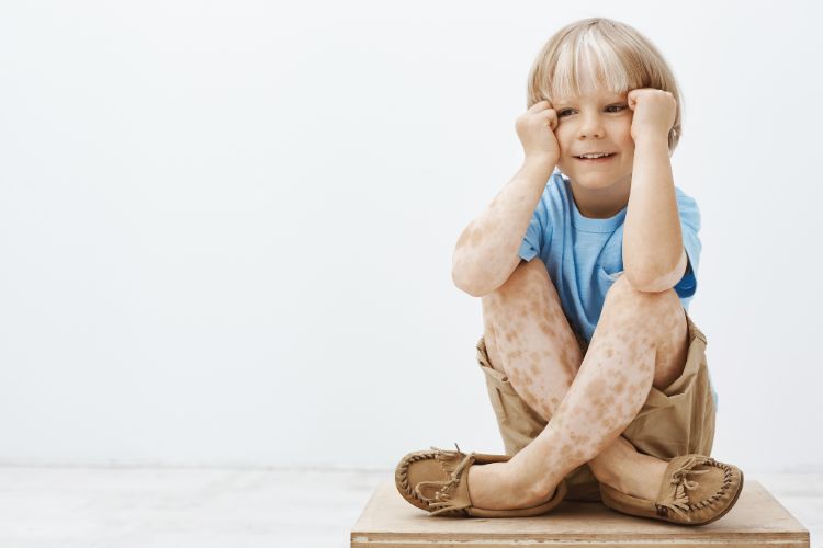 Vitiligo en niños: qué es, cómo reconocerlo, tratamientos seguros y cómo acompañar a tu hijo emocionalmente