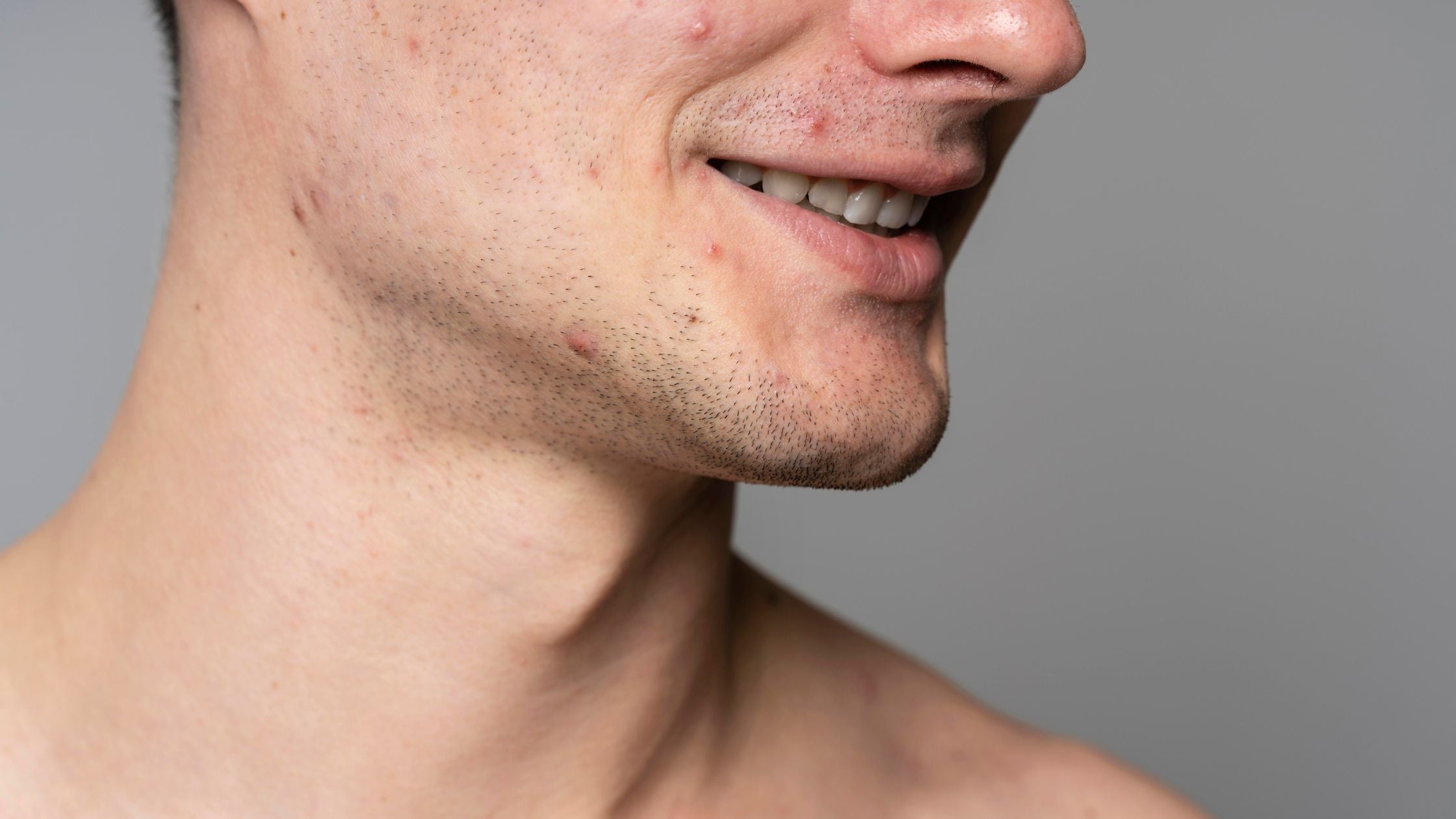 Acné en la mandíbula qué significa: causas hormonales, diferencias por género y cómo tratarlo