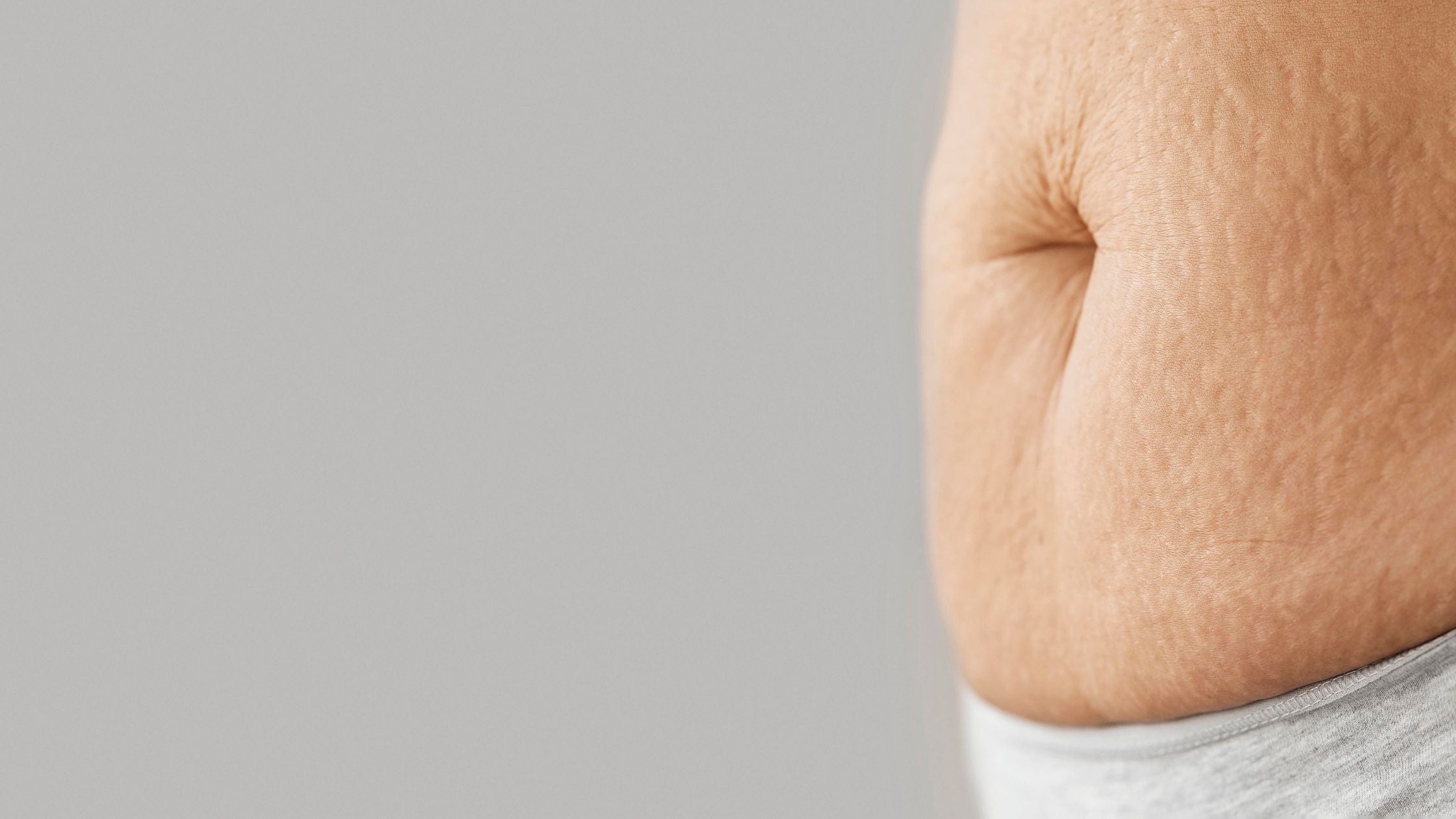 ¿Las celulitis se pueden quitar? La respuesta honesta que nadie te da, qué tratamientos realmente funcionan y qué resultados puedes esperar según tu grado