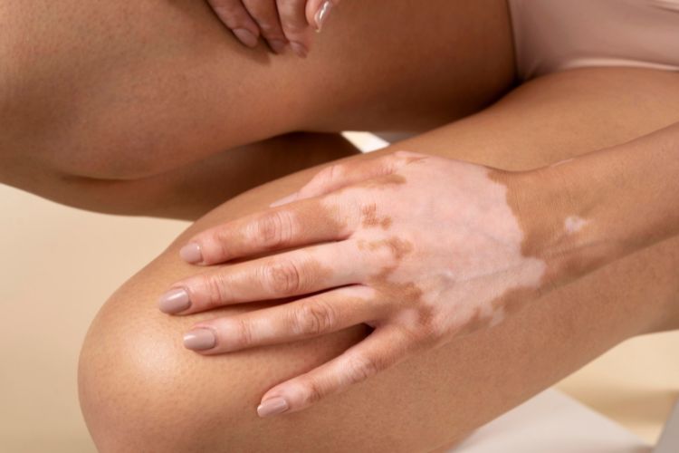 Vitiligo qué es: causas, tipos, tratamientos actuales y el cuidado de la piel que todo paciente necesita conocer