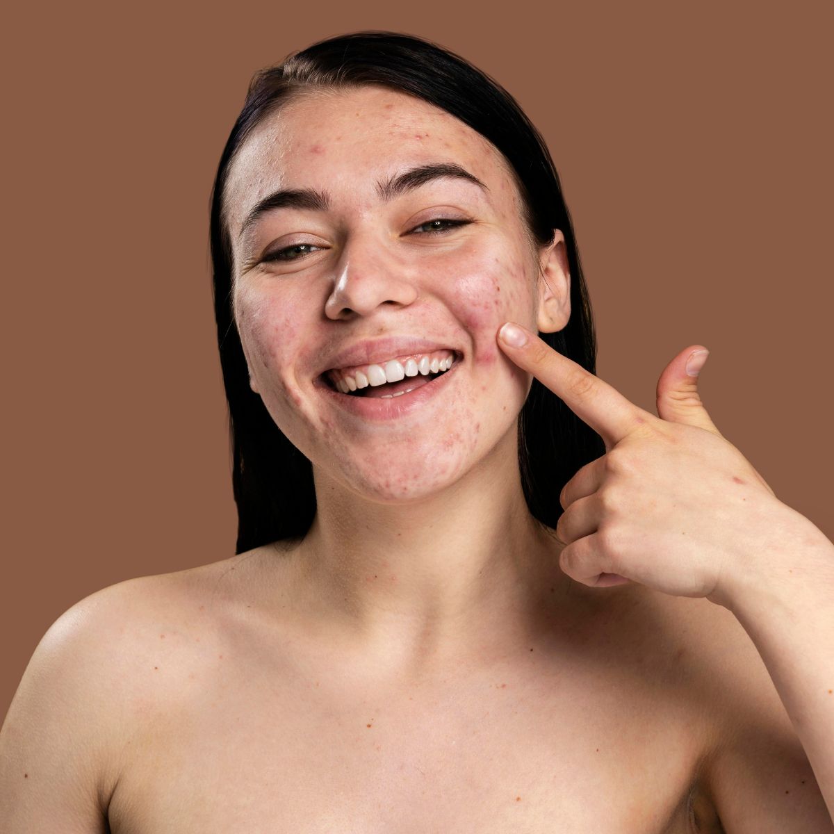 Espinillas en la espalda y pecho: Guía definitiva para una piel libre de imperfecciones