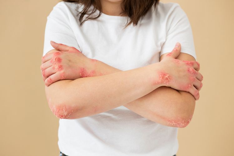 Psoriasis tratamiento: de la crema al biológico — la guía completa para entender cada opción y cuándo usarla