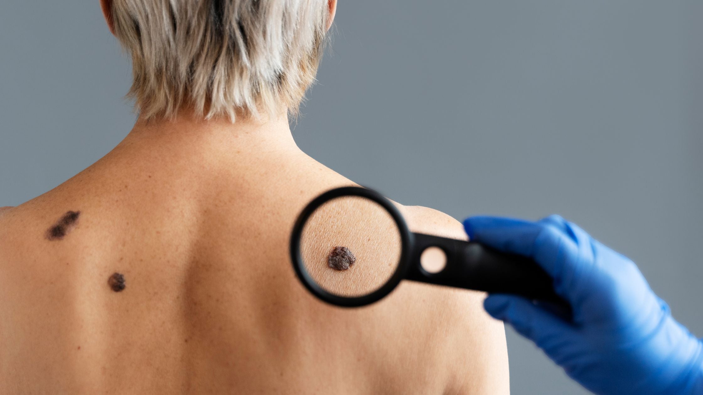 Queratosis pilaris: qué es la "piel de gallina", por qué aparecen esos bultitos en los brazos y el tratamiento que realmente suaviza la piel
