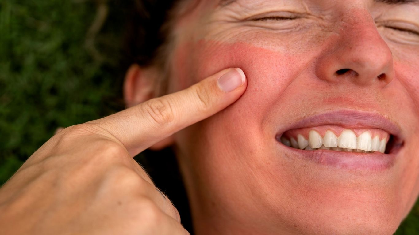 Rosácea que es y tratamiento: Guía completa para calmar y proteger tu piel