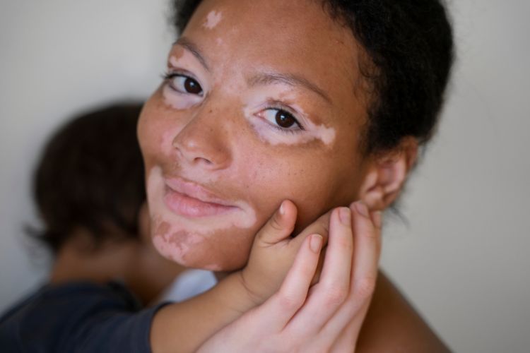 Vitiligo causas: la ciencia detrás de las manchas blancas — genética, autoinmunidad, estrés oxidativo y los desencadenantes que nadie menciona